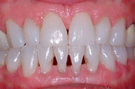 Black Triangle Teeth or Gingival Embrasures: Causes & Treatments