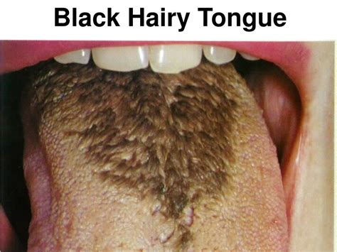 Black hairy tongue is a temporary condition that can occur