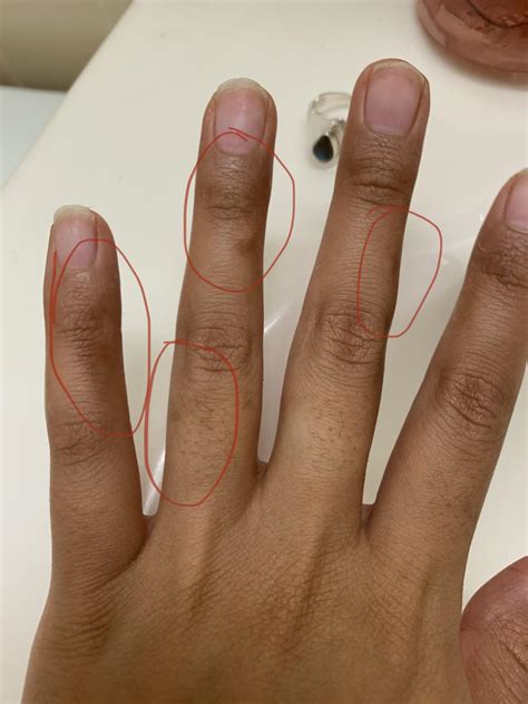 Black spot on finger Dermatology Forums Patient