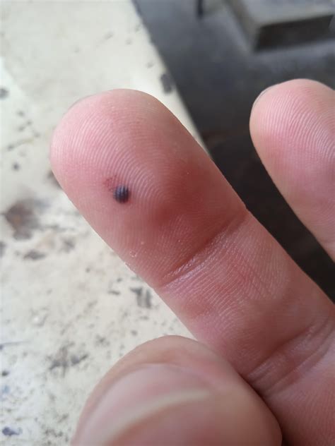 Black thing came out of my skin. .  ...