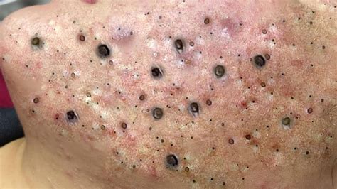 Blackhead and cyst removal videos 2021 loan nguyen youtube. December 3, 2021. Loan Nguyen returns with her relaxing pimple popping acne spa. Of course she’s unable to get everything out of the pore, which is frustrating to... 