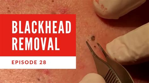 Recommended treatments for Blackhead Removal. Chemical Peels. C