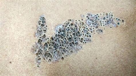 Blackhead cluster. A person appearing to be a doctor (thanks to the gloves and the scalpel-style tool) extracts and pops a cluster of extremely large, ripe blackheads from someone's face. When you think there... 