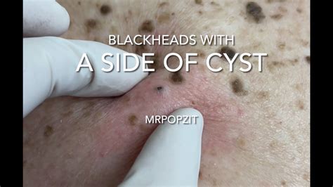 Blackhead cyst. These 25 pops are some real doozies! 25 Best Cyst Popping Videos From Dr. Pimple Popper. 1. Cheek Explosion. A cheek explosion. An absolute cheek-splosion. 2. The Mashed Potato. No, it's not a ... 