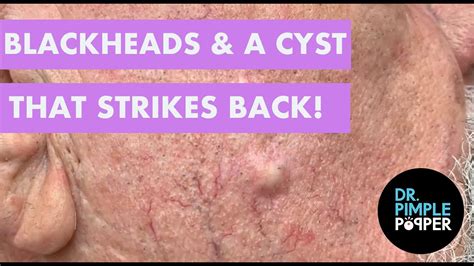 Blackhead cyst on back. Method 1 Giving Basic Treatment at Home Download Article 1 Apply a warm compress. Soak a clean washcloth, cotton pad, or sponge in warm water and apply it directly to the cyst. Keep it on the area until the cloth or pad cools down. Repeat this action several times each day until the cyst goes away. [2] 