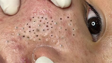 Blackhead eyelid. 😱 A special treat for our #FridaySqueeze! Clusters of blackheads and whiteheads extracted all around the patient's eyes. Did the beginning give you some try... 