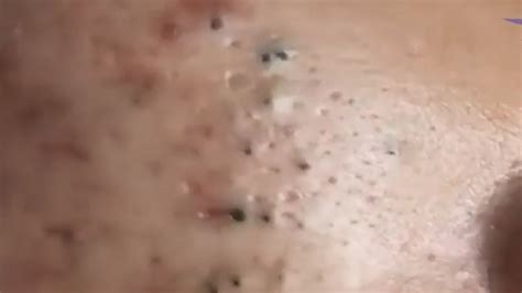 ow to skincare,popping big pimples,cystic acne removal close up,dilated pore of winer ,pimple popper blackhead on face,whiteheads around nose,blackhead white.... 