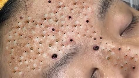 Remove blackheads from the face. Click on the link to participate in the giveaway to 🔥 win 🔥 Amazon Gift Card Codes💳 💵💵 $250 💰💰💸 : ⚡️⚡️ https://agoo...