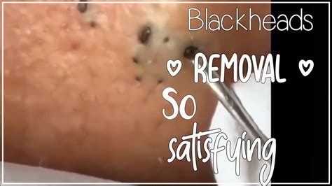 Relax to This Video at The Loan Nguyen Spa for Acne Treatment!Most satisfying Pimple Popping and Blackhead Removal.Subscribe & Like For More!#relax #loannguy...