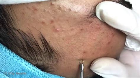 This blackhead extraction video includes several pores with huge extract that finally had the blackheads removed from it without any issues, super satisfying!. 
