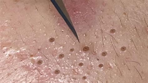 Blackheads 2023 new videos youtube. Clusters of Blackheads with Dr. Pimple Popper. Dr. Pimple Popper. 8.32M subscribers. Subscribed. 20K. 2.7M views 11 months ago #SLMD #DrPimplePopper #DrSandraLee. Click here to subscribe to Dr ... 