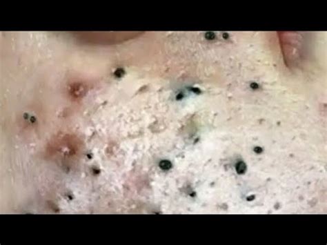 Blackheads 2023 new videos youtube today. By Emily J. Shiffer Published: May 26, 2021. In Dr. Pimple Popper's new Youtube video, she squeezes a giant blackhead on her patient's back. This is a massive bump that looks like it's oozing out ... 