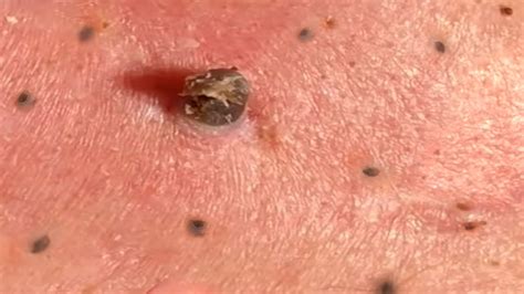Thanks for looking: Giant Blackhead Removal on the Back - Blackhead Removal 2021All credit to Dermamatic SATISFY. Visit them for more awsome blackhead remov...