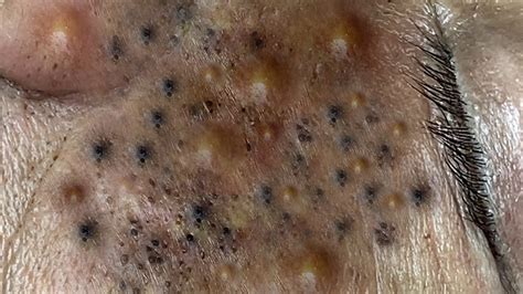 Blackheads on elderly. Blackheads are something we are all familiar with, but did you know they are also called open comedones? Blackheads are usually caused by a pore that gets cl... 