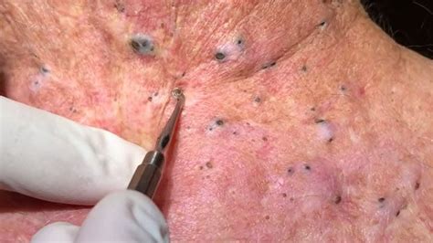 Here are 30 of the craziest, most satisfying blackhead, cyst, and pimple popping videos and extractions. 1. Classic Pimple Popping. This zit extraction video is zoomed in super far, so you can see .... 