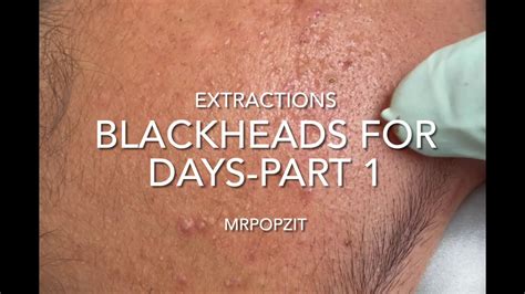 Blackheads pimples part 1. So for the most part, this video doesn’t do it for me. But there’s this one glorious moment in the video where Enilsa pulls out a 4-inch long ingrown hair. When I first saw that, I played it back about a million times. But ingrown hairs are my jam. FYI: skip to 7:11 to see it in action. 6. Blackhead Extractions on Leslie 