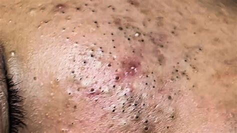 Blackheads popped on face. Acne extractions. Your new favorite extraction video part 1. With over 20 minutes of just the pop. I edit out all the prep work. This patient has very severe... 