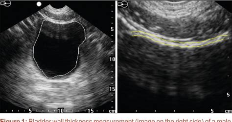 Bladder wall thickness in normal adults and men with