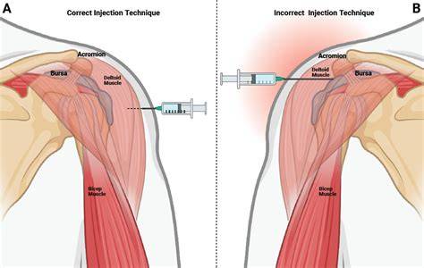 Bleeding after im injection in deltoid.  Scope This resource is intended for immunize...