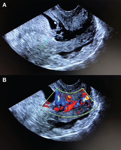 Bleeding cervical varices in pregnancy: A case report and