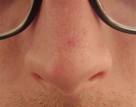 Fibrous papule of the nose (syn.: benign solitary fibrous papule,