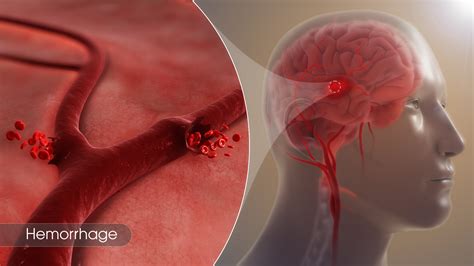 Bleeding special effects.  A hemorrhage is severe bleeding.  Learn about the causes of...