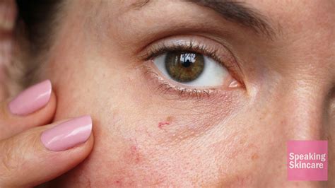 Blemishes: Symptoms, Treatment & Causes - Dr. Chhabra