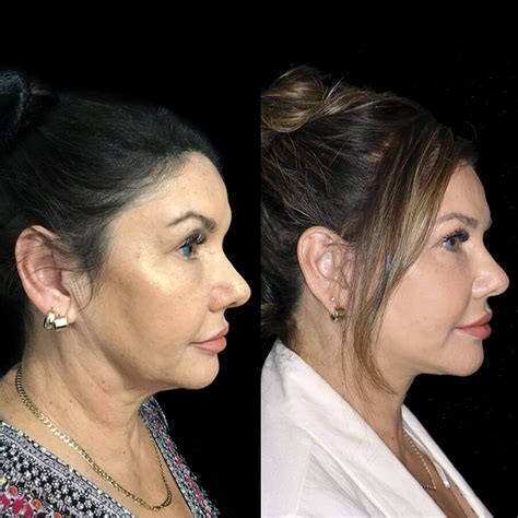 Blepharoplasty vs. Thread Lift: What’s the difference?