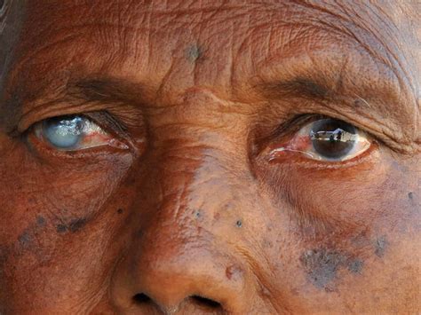 Blindness & Low Vision – Northwest Access Fund