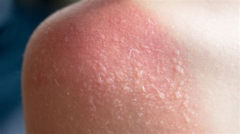 Blister in the sun. Some melanomas in their earliest stages may resemble blood blisters and reveal themselves as such if they continue to grow rather than disappearing in a reasonable time frame, stat... 