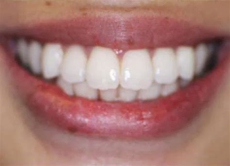 Blog What Are Porcelain Veneers? Kate Brayman DDS