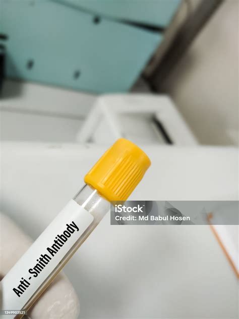 Blood Sample For Anti Smith Antibodies Test Diagnosis And Monitoring Of