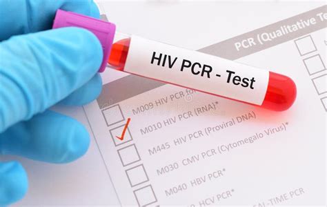 Blood Sample for HIV PCR Test Stock Image Image of microbiology
