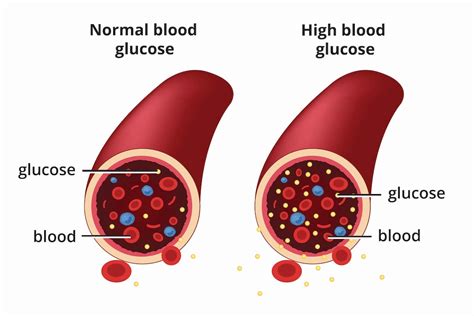 Blood Sugar Levels For Teenager Long Term Side Effects Of High Blood …