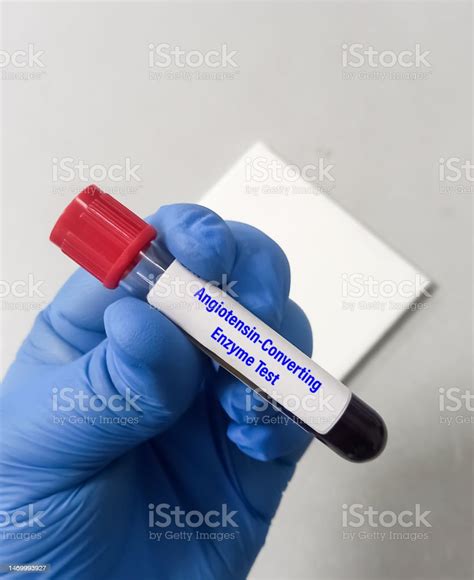 Blood Test Sample For Angiotensinconverting Enzyme Test Stock Photo
