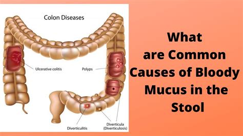 Blood and mucus in stool