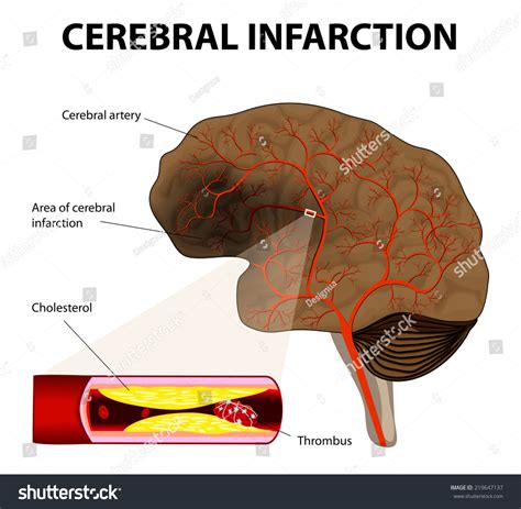 Blood clot in brain/stroke: - Narayana Health