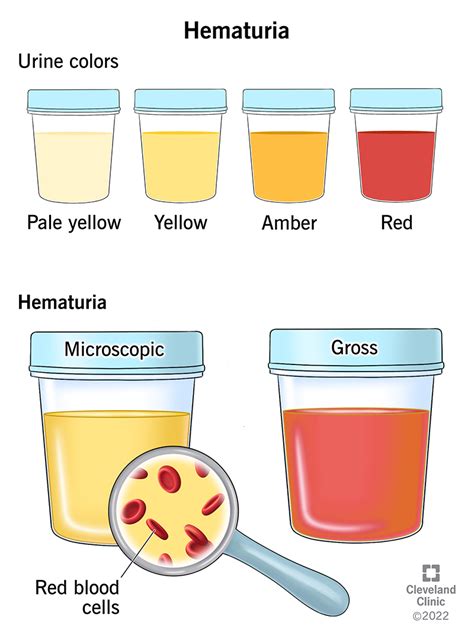 Blood in pee meaning