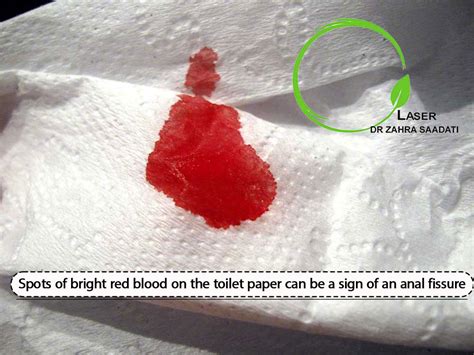 Blood in stool and when i wipe