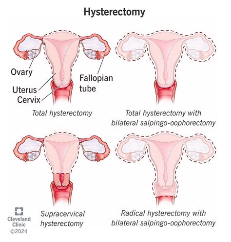 Body positoning hysterectomy pics.  Understanding hysterectomy is quite a com...