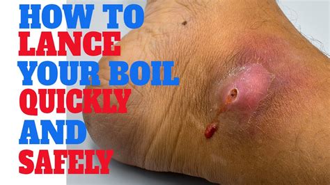 Boil lancing. Boils will normally rupture on their own and then heal within a week or so. But if your boil persists and is unchanged after 2 weeks, talk to your doctor. They can examine your boil and recommend treatment options. They may prescribe a cream that can help get rid of the boil. Your doctor may decide to lance the boil themselves. 