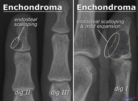 Bone: Chondroma