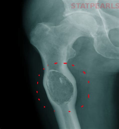 Bone Cyst - StatPearls - NCBI Bookshelf