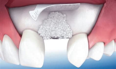 Bone Graft and Membrane Procedure at America …