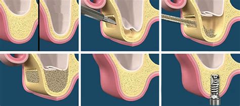 Bone Grafts - Sinus Lift