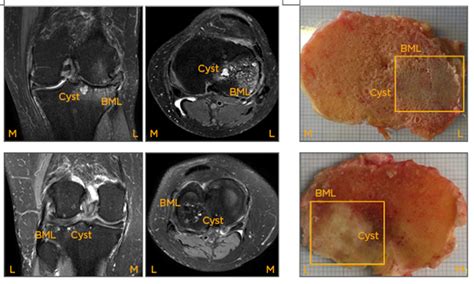 Bone Marrow Degenerative Changes