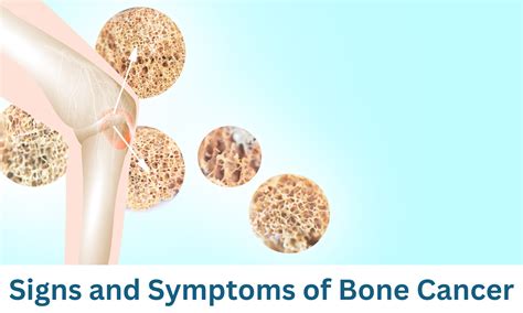 Bone cancer symptoms patient stories. .  ...
