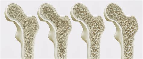 Bone density test Spanish Translator