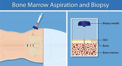 Bone marrow aspiration & trephine biopsy - SlideShare