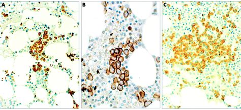 Bone marrow immunohistology of plasma cell neoplasms